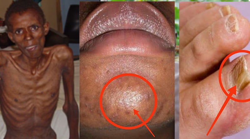 WARNING: Early Symptoms Of HIV In Men You Should Never Ignore 2 HIV