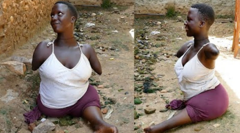 Check out the Heartbreaking story of a girl who was born without a limb. 2 Check out the Heartbreaking story of a girl who was born without a limb.
