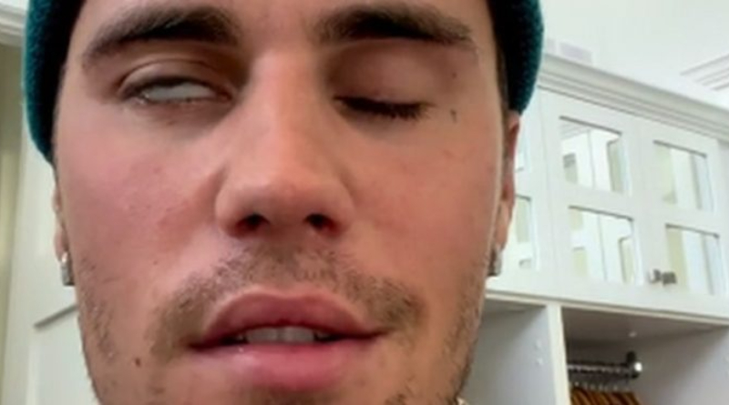 Justin Bieber reveals facial paralysis after shows canceled 2 Justin Bieber