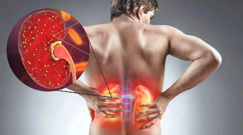 You are killing your kidney slowly with these 7 practices 2 killing your kidney